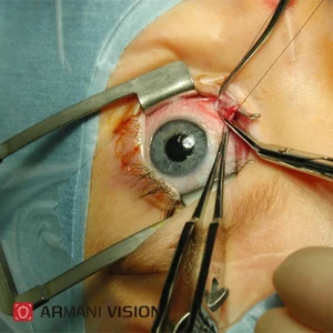جراحی چشم چیست