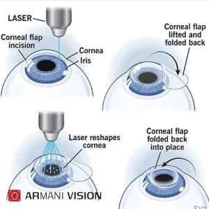 دلایل استفاده از عینک بعد از عمل لیزیک 