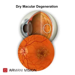 دژنراسیون ماکولا وابسته به سن (AMD)
