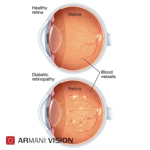 رتینوپاتی دیابتی