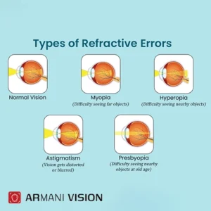 انواع عیوب انکساری چشم